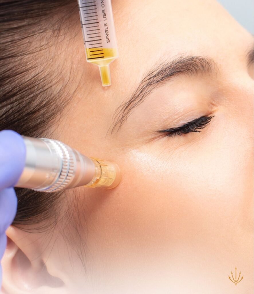 Mikroadatinė mezoterapija (Microneedling)
