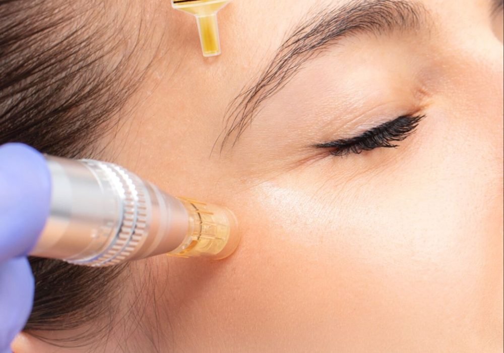 Mikroadatinė mezoterapija (Microneedling)