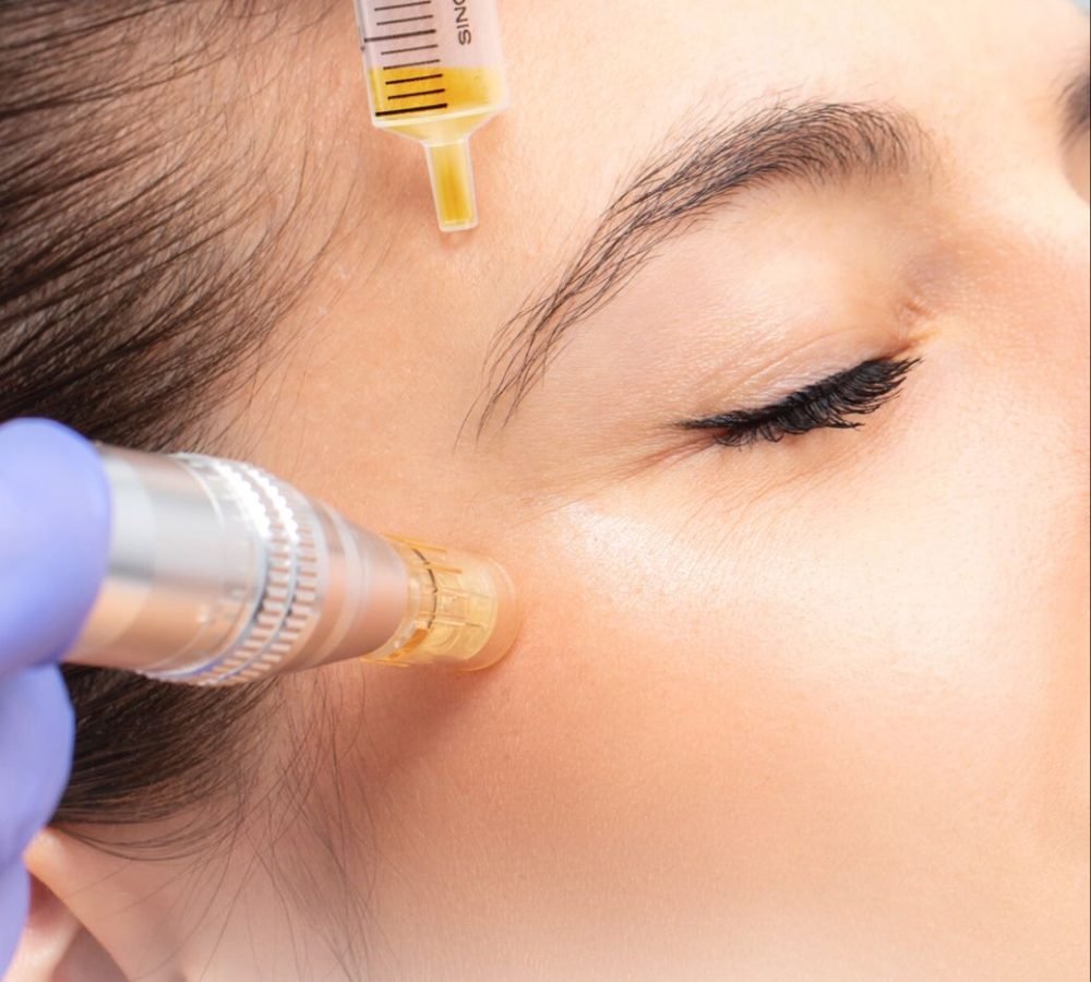 Mikroadatinė mezoterapija (Microneedling)
